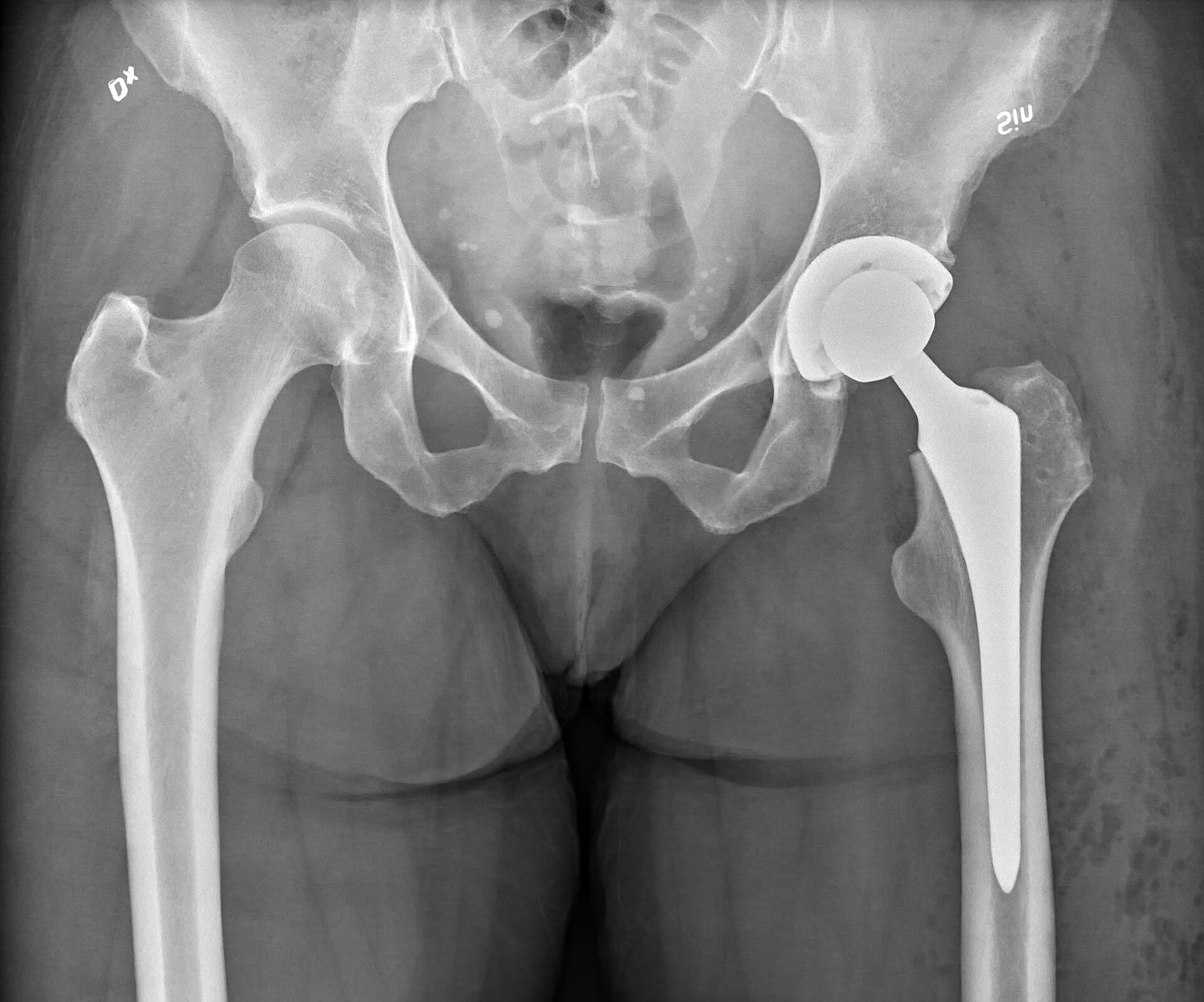 Total Hip Replacement