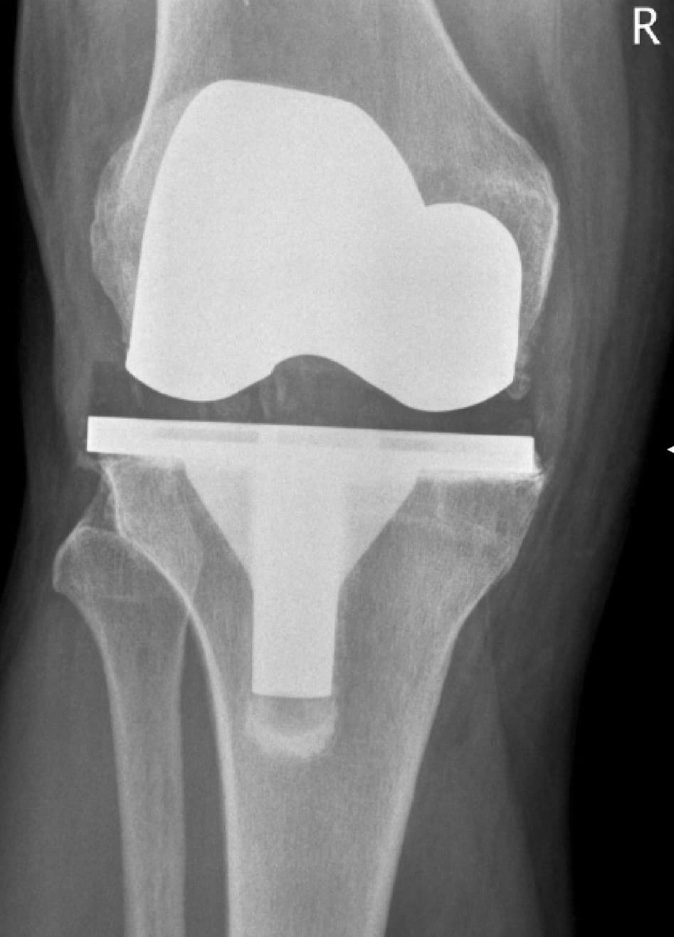 Revision Joint Replacement