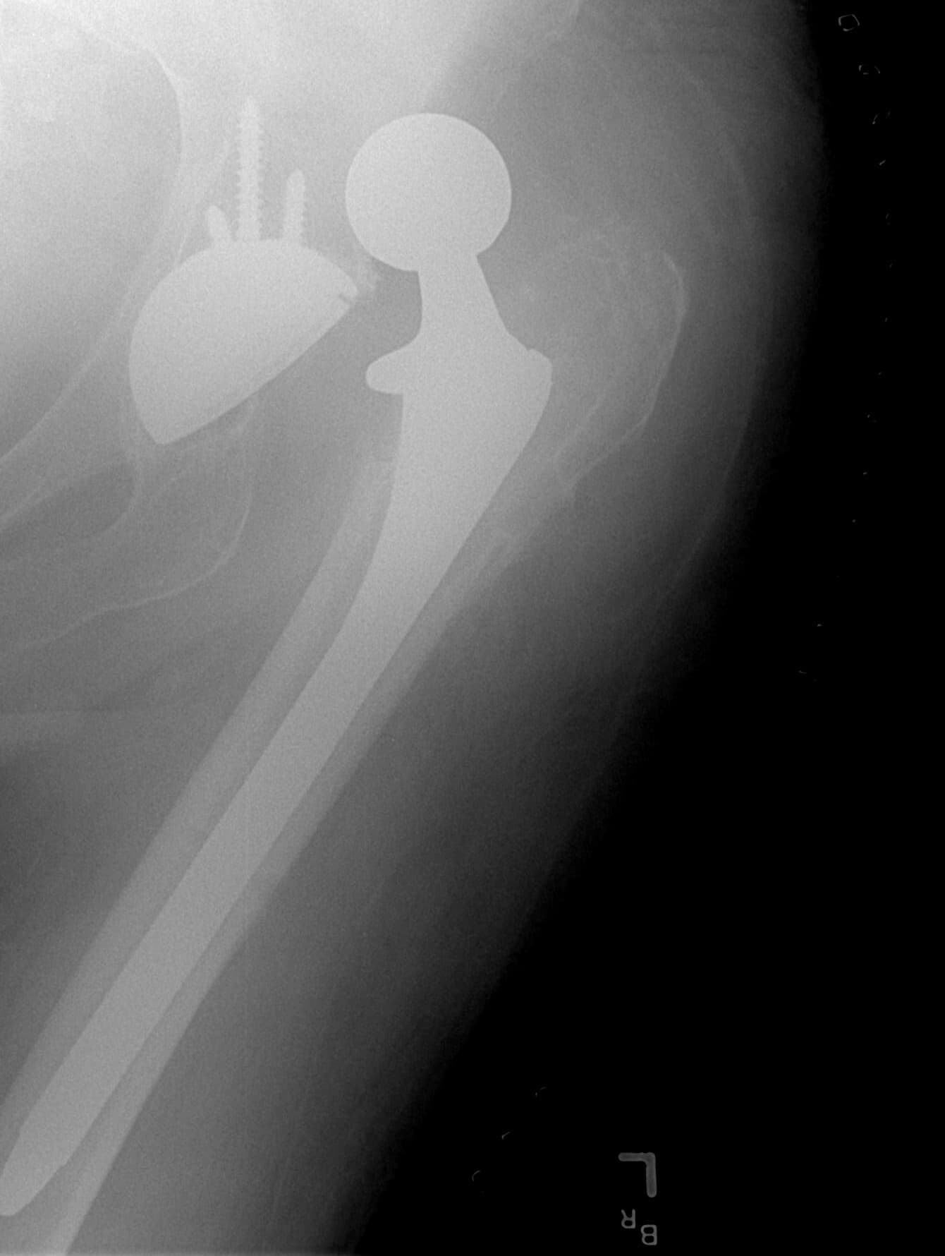 Revision Hip Replacement