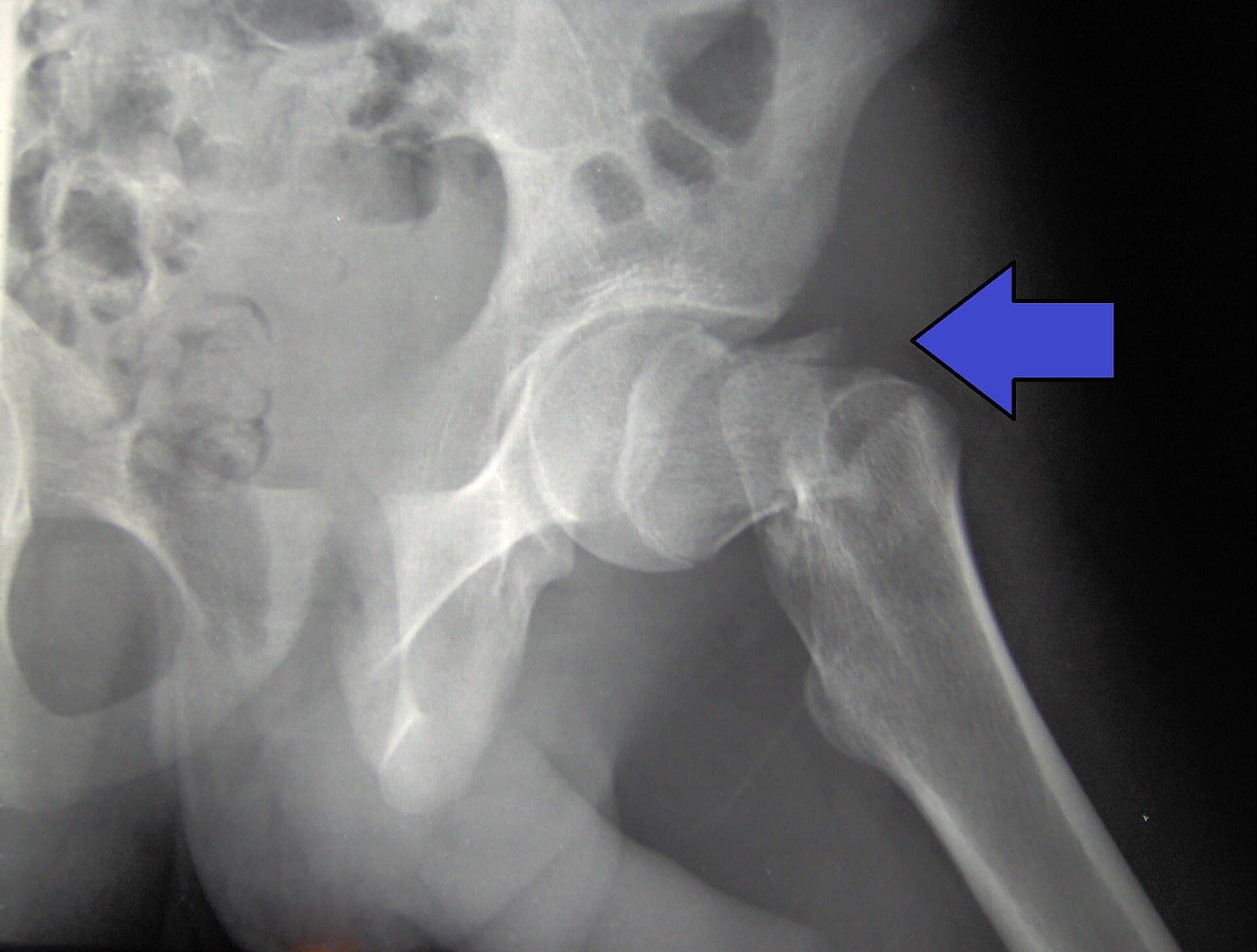 Hip fracture in the elderly: why the first 48 hours matter