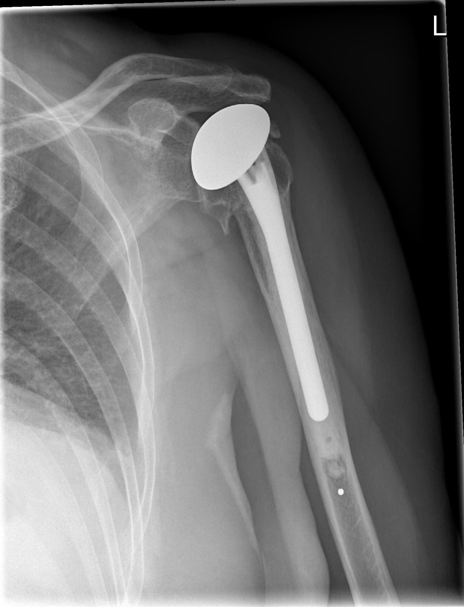 Shoulder Replacement