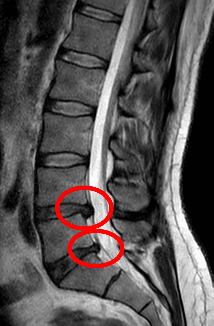 Back Pain & Prolapse Disc