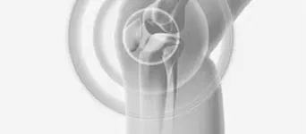 Revision Knee Replacement