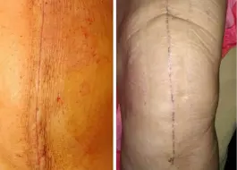 Sutureless Knee Replacement